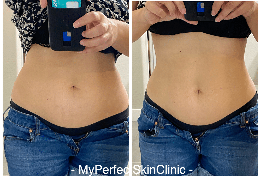 Need to get rid of excess fat pockets and achieve that silhouette shape -Why Choose Body Contouring?