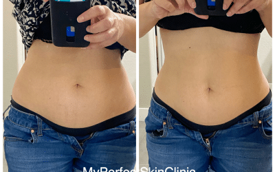 Need to get rid of excess fat pockets and achieve that silhouette shape -Why Choose Body Contouring?