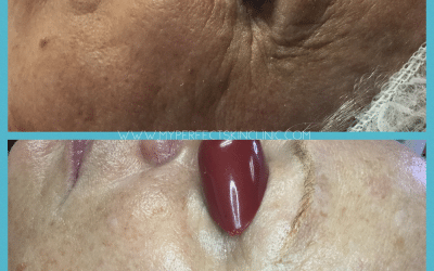 Choosing The Right Anti Aging Facial