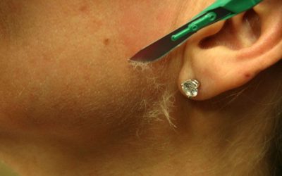 Dermaplaning – Specialized Face Shaving for Beautiful Skin