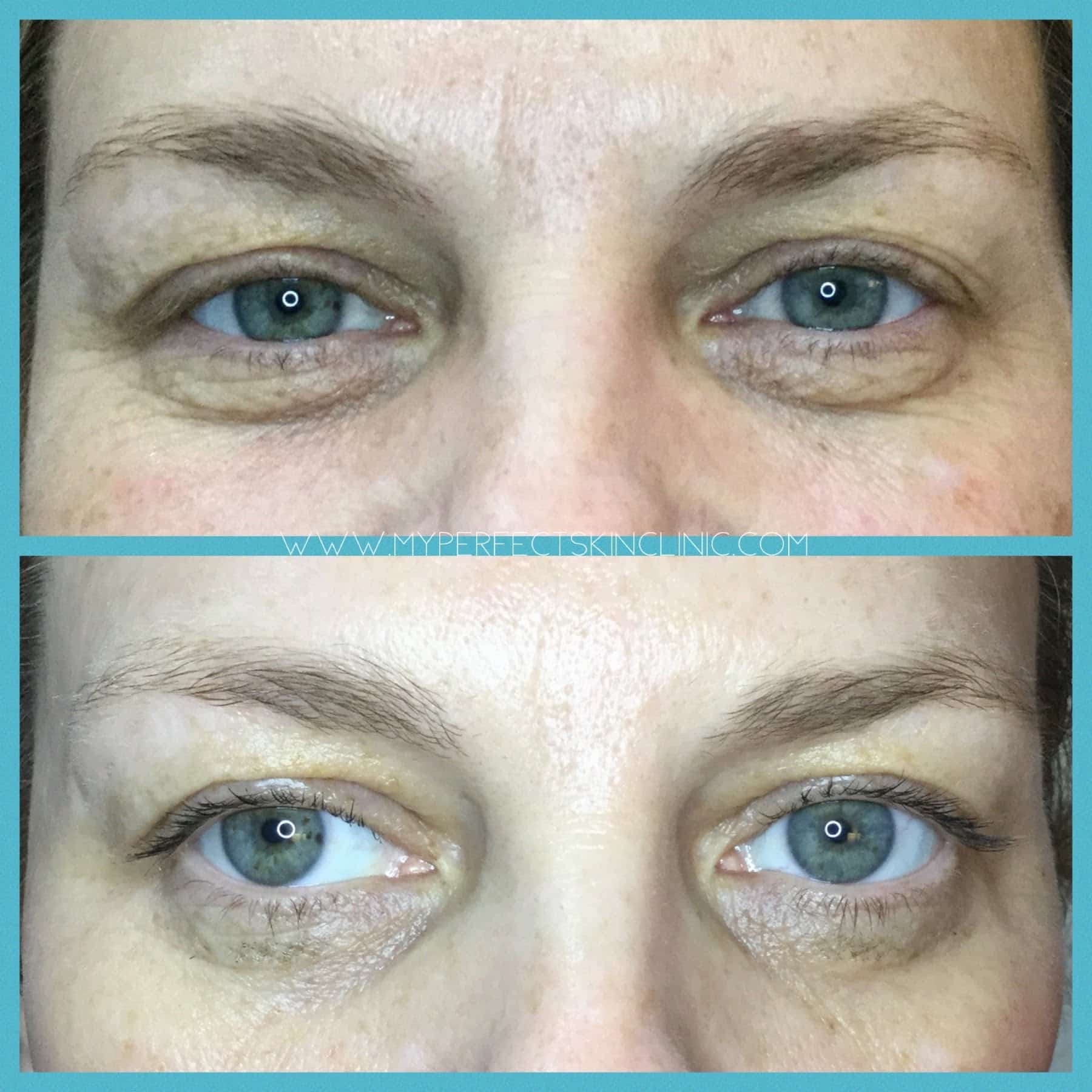 Eyelid tightening/under-eye treatment and excess upper eyelid skin