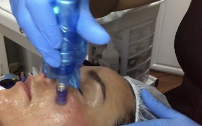 Microneedling