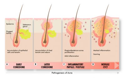 All About Acne – Part 1