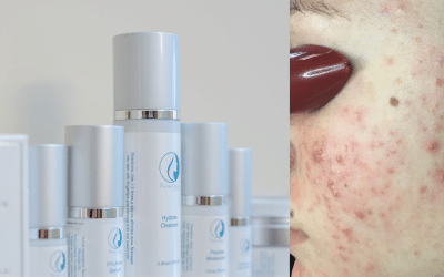 Acne Causes and Treatment