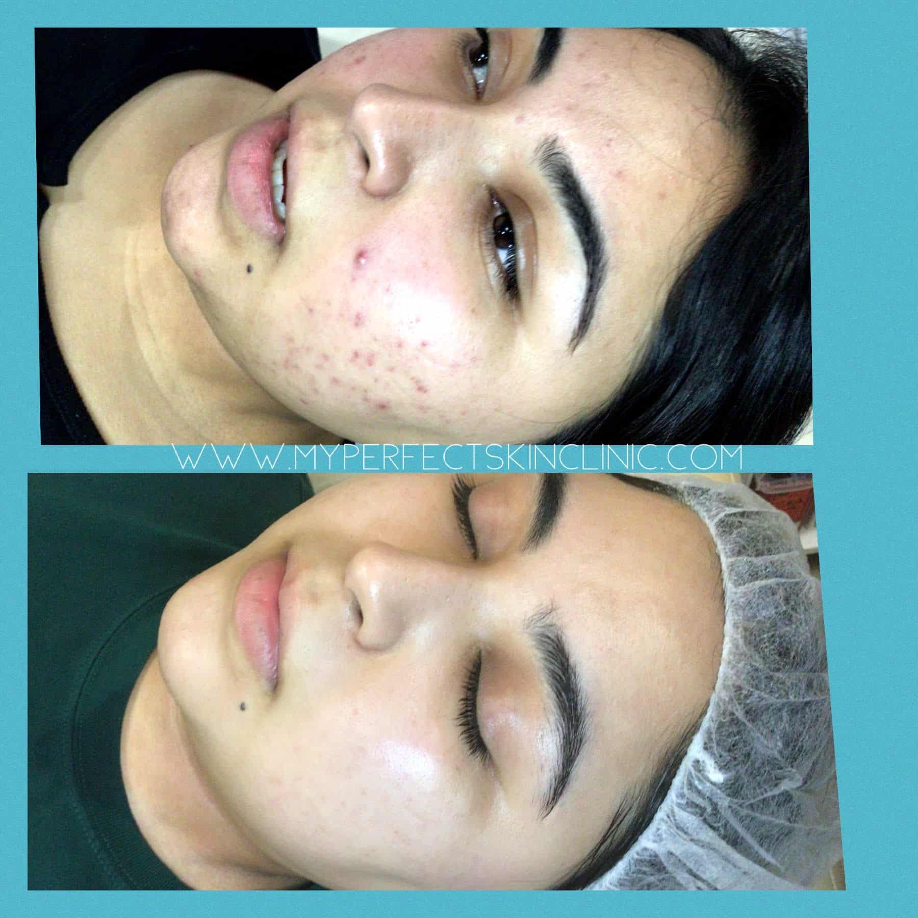 Acne Treatment Clear Results