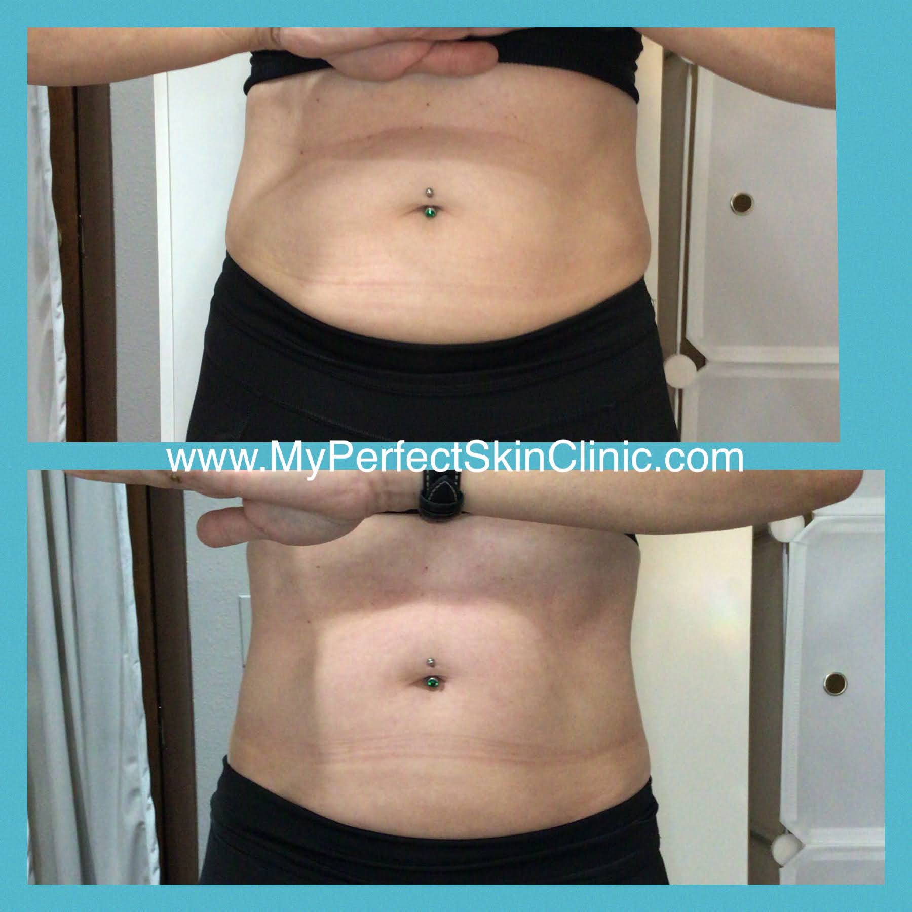 Body Sculpting - Cellulite Reduction - Before and After