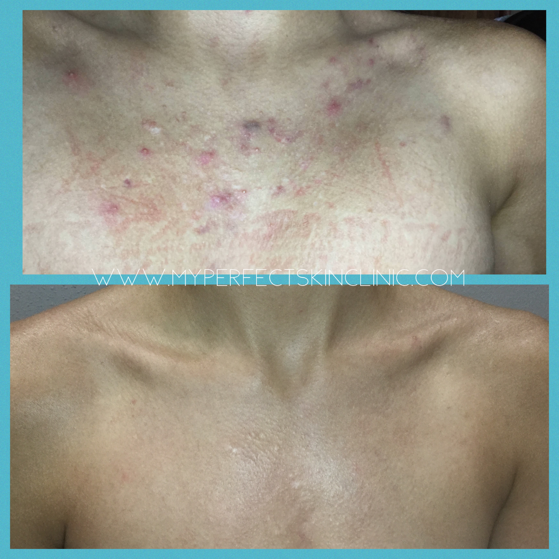 Cystic Acne Chest Before After