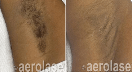 Before and after look at underarm hair removal