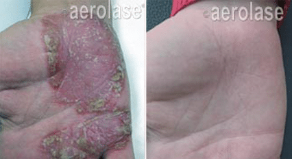 Laser skin treatment for psoriasis