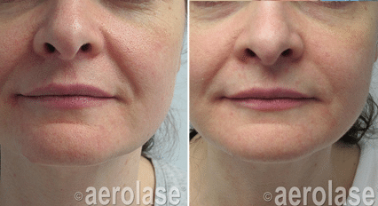 Before and after look at skin rejuvenation treatment