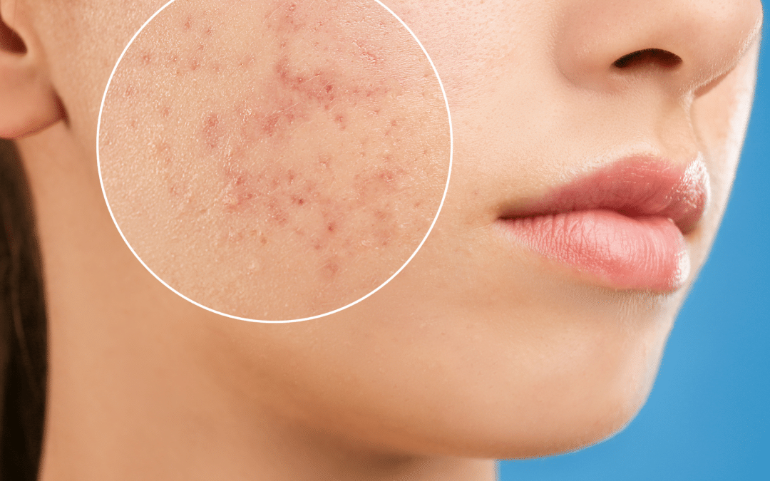 ARE FACIAL SCARS TREATABLE?