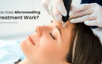 How Does Microneedling Treatment Work?  