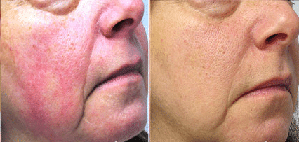 Rosacea treatment - before and after look at a patient's face