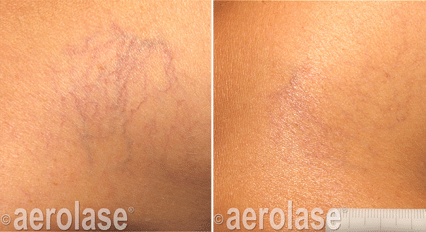 Before and after look at the Aerolase treatment on a patient's spider veins