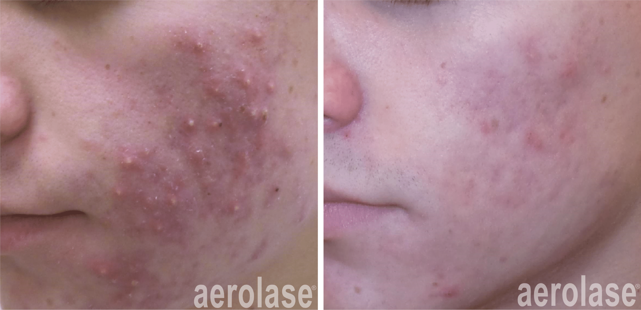 Aerolase before and after treatment
